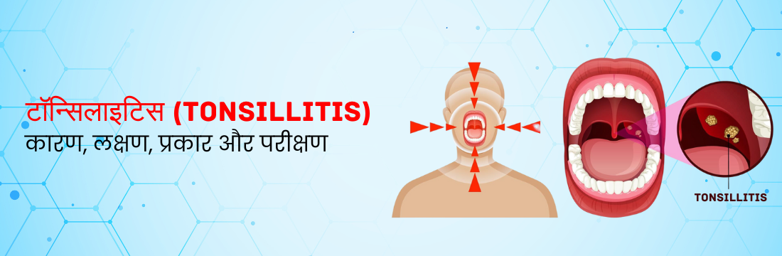 टॉन्सिलाइटिस: कारण, लक्षण, प्रकार और परीक्षण